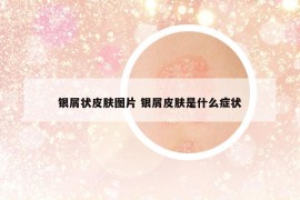 銀屑狀皮膚圖片 銀屑皮膚是什么癥狀