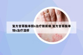 復(fù)方甘草酸單胺s治療銀屑病 復(fù)方甘草酸單銨s治療濕疹