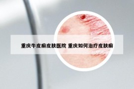 重慶牛皮癬皮膚醫(yī)院 重慶如何治療皮膚癬