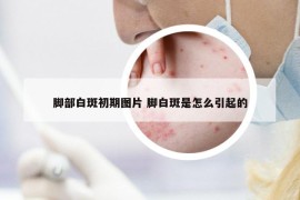 腳部白斑初期圖片 腳白斑是怎么引起的