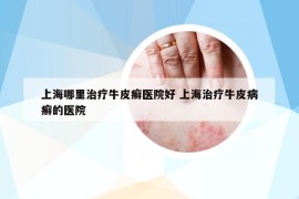 上海哪里治療牛皮癬醫(yī)院好 上海治療牛皮病癬的醫(yī)院