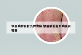 銀屑病會有什么并發(fā)癥 銀屑病引起的病變有哪些