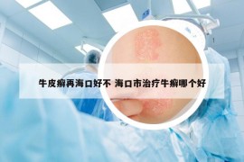 牛皮癬再?？诤貌?海口市治療牛癬哪個(gè)好