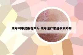 紫草對牛皮癬有效嗎 紫草治療銀屑病的妙用