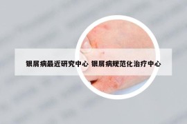 銀屑病最近研究中心 銀屑病規(guī)范化治療中心