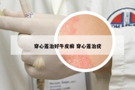 穿心蓮治好牛皮癬 穿心蓮治疣