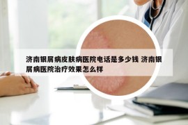 濟南銀屑病皮膚病醫(yī)院電話是多少錢 濟南銀屑病醫(yī)院治療效果怎么樣