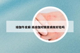 瑜伽牛皮癬 練瑜伽對銀屑病有好處嗎