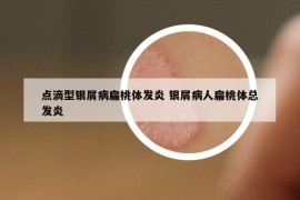 點(diǎn)滴型銀屑病扁桃體發(fā)炎 銀屑病人扁桃體總發(fā)炎