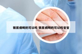 銀屑病喝奶可以嗎 銀屑病喝奶可以嗎寶寶