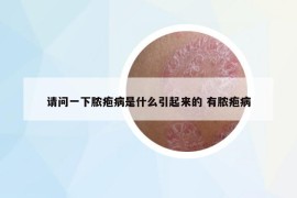 請問一下膿皰病是什么引起來的 有膿皰病