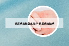 銀屑病皮膚怎么治療 銀屑病皮膚病