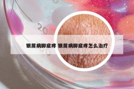 銀屑病腳底疼 銀屑病腳底疼怎么治療