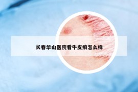 長(zhǎng)春華山醫(yī)院看牛皮癬怎么樣