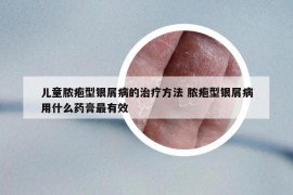 兒童膿皰型銀屑病的治療方法 膿皰型銀屑病用什么藥膏最有效
