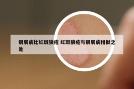銀屑病比紅斑狼瘡 紅斑狼瘡與銀屑病相似之處