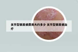 關(guān)節(jié)型銀屑病費(fèi)用大約多少 關(guān)節(jié)型銀屑病治療
