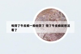 唉得了牛皮癬一般收獲了 得了牛皮癬就想活著了