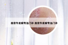 南京牛皮癬專治門診 南京牛皮癬專治門診