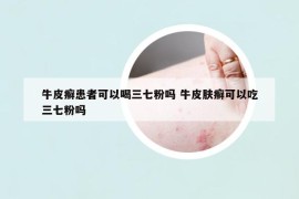 牛皮癬患者可以喝三七粉嗎 牛皮膚癬可以吃三七粉嗎