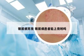 銀屑病宵夜 銀屑病患者能上夜班嗎