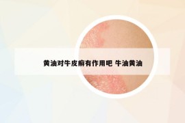 黃油對牛皮癬有作用吧 牛油黃油