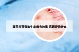 真菌抑菌膏治牛皮癬有效果 真菌膏治什么
