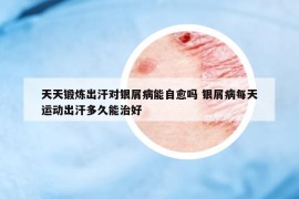 天天鍛煉出汗對銀屑病能自愈嗎 銀屑病每天運(yùn)動出汗多久能治好