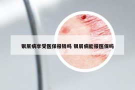 銀屑病享受醫(yī)保報(bào)銷嗎 銀屑病能報(bào)醫(yī)保嗎
