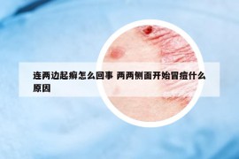 連兩邊起癬怎么回事 兩兩側面開始冒痘什么原因