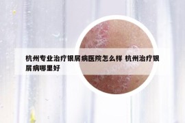 杭州專業(yè)治療銀屑病醫(yī)院怎么樣 杭州治療銀屑病哪里好