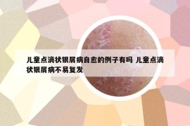 兒童點滴狀銀屑病自愈的例子有嗎 兒童點滴狀銀屑病不易復(fù)發(fā)