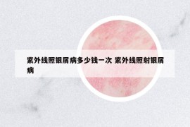 紫外線照銀屑病多少錢一次 紫外線照射銀屑病