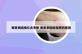 銀屑病結(jié)痂紅點(diǎn)發(fā)硬 銀屑病結(jié)痂變厚的原因