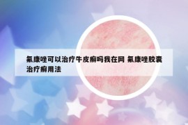 氟康唑可以治療牛皮癬嗎我在網(wǎng) 氟康唑膠囊治療癬用法