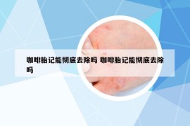 咖啡胎記能徹底去除嗎 咖啡胎記能徹底去除嗎