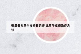 哪里看兒童牛皮癬看的好 兒童牛皮癬治療方法