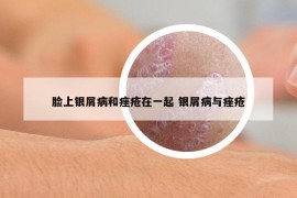 臉上銀屑病和痤瘡在一起 銀屑病與痤瘡