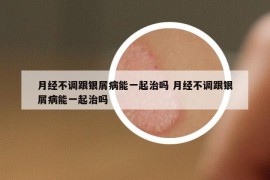 月經(jīng)不調(diào)跟銀屑病能一起治嗎 月經(jīng)不調(diào)跟銀屑病能一起治嗎