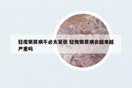輕度銀屑病不必太緊張 輕微銀屑病會(huì)越來(lái)越嚴(yán)重嗎
