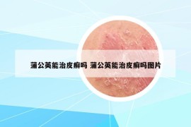 蒲公英能治皮癬嗎 蒲公英能治皮癬嗎圖片