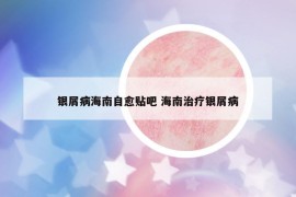 銀屑病海南自愈貼吧 海南治療銀屑病