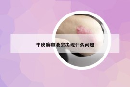 牛皮癬血液會(huì)出現(xiàn)什么問題