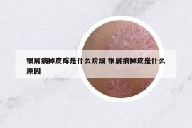 銀屑病掉皮癢是什么階段 銀屑病掉皮是什么原因
