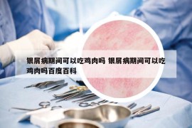 銀屑病期間可以吃雞肉嗎 銀屑病期間可以吃雞肉嗎百度百科