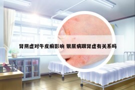 腎陰虛對牛皮癬影響 銀屑病跟腎虛有關(guān)系嗎