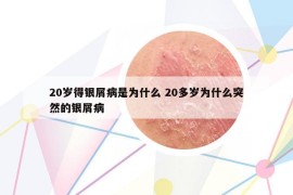 20歲得銀屑病是為什么 20多歲為什么突然的銀屑病