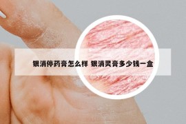 銀消停藥膏怎么樣 銀消靈膏多少錢一盒