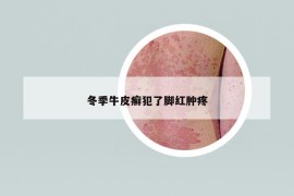 冬季牛皮癬犯了腳紅腫疼