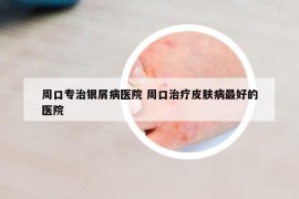 周口專治銀屑病醫(yī)院 周口治療皮膚病最好的醫(yī)院